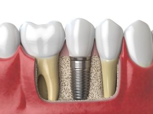 geotagged_anatomy-of-healthy-teeth-and-tooth-dental-implant-PAF6ZMW (1)